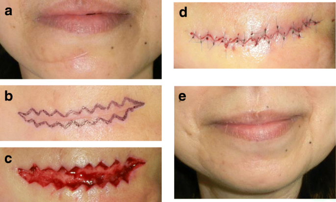 Z-Plasty for Scar Revision